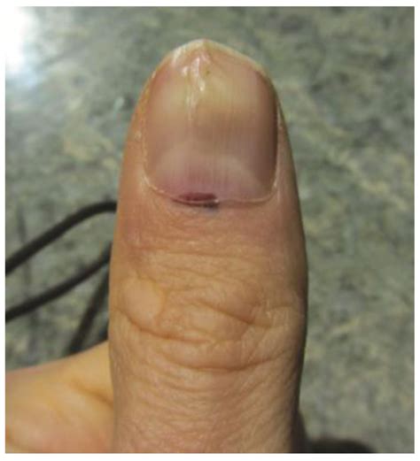 beginning fingernail melanoma pictures